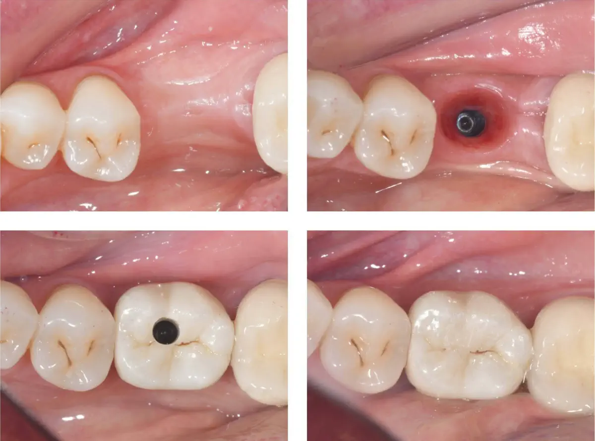 Zubní implantát
